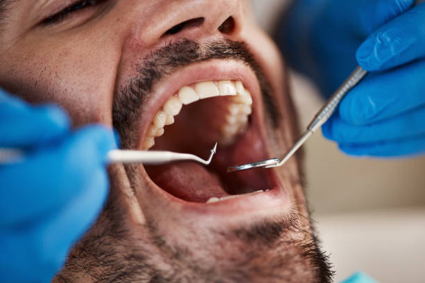 Best Emergency Tooth Extraction in Summit View, WA