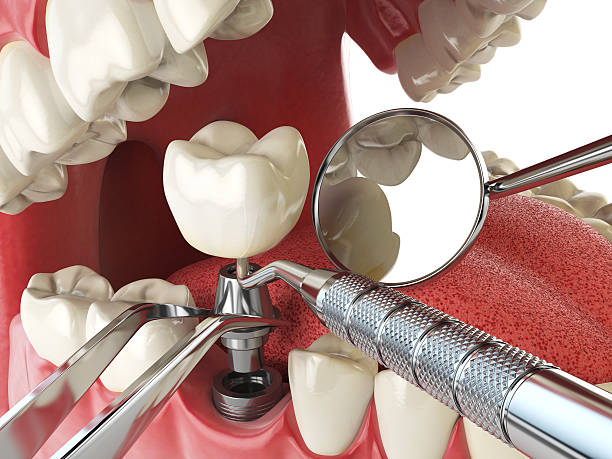 Best Emergency Tooth Extraction in Summit View, WA